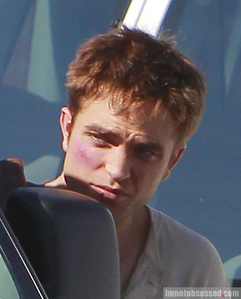  my gorgeous Robert with a bruise just under his right eye.Let me キッス it and make it all better,baby<3
