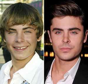  Zac Efron - Then and Now
