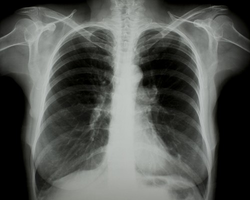  X ray Chest