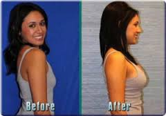  Before and After of Breast Enlargement Pills