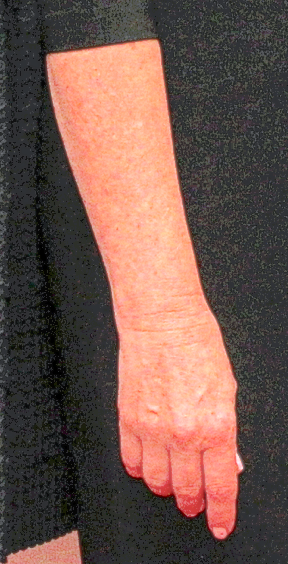 Debbie's Arm